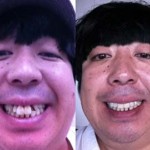 【驚愕】インプラントで真っ白な歯に治療した芸能人　5選